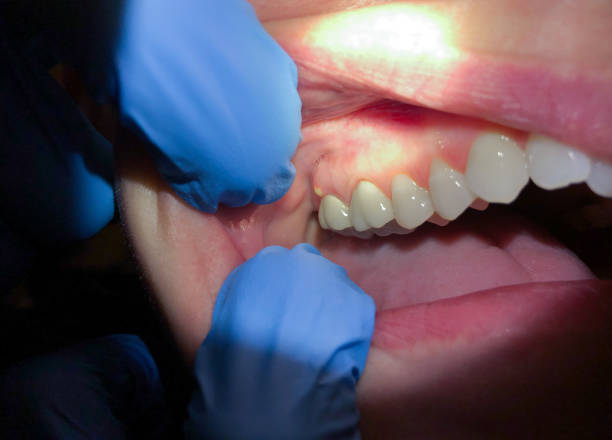Best Emergency Wisdom Teeth Removal in Norton Shores, MI