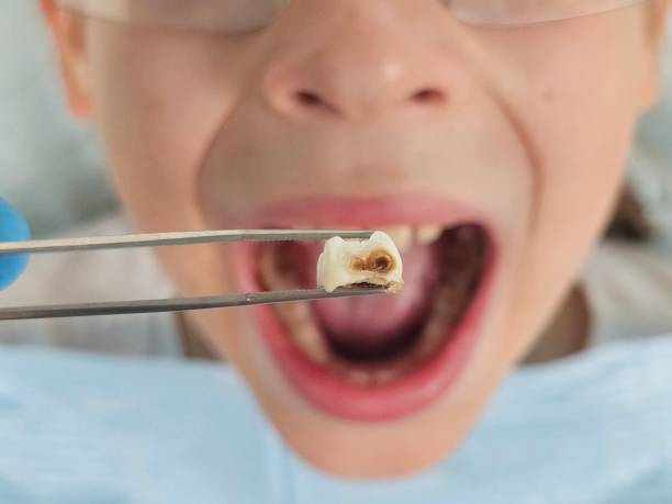 Best Emergency Tooth Extraction in Norton Shores, MI